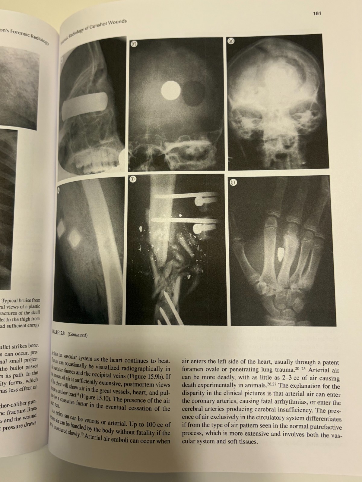 Brogdon’s Forensic Radiology by Michael J Thali M D: Used
